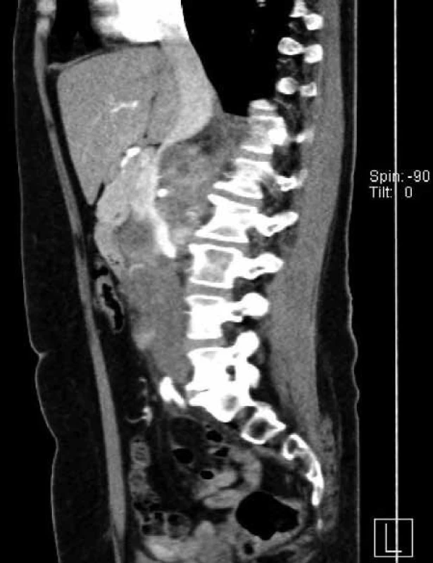 Žena, 57 let, objemný tumor pravé ledviny T3aN2M0. Primární tumor uložený v dolním pólu a střední části ledviny v největším rozměru 10 cm, mnohočetné objemné splývající pakety uzlin před i za dolní dutou žilou zaujímající do sebe i hilové cévy. Nález hodnocen jako radikálně inoperabilní. Biopsií pod CT verifikován světlobuněčný renální karcinom grade 2 dle Fuhrmannové. Nález byl indikován k downsizingu pomocí biologické léčby. Pacientka léčbu sunitinibem bohužel špatně toleruje (zvracení). 1A –axiální řez, 1B – ární řez, 1C – ální řez
Fig. 1. Woman 57-year-old with advanced renal tumour of the right kidney T3aN2M0, biopsy clear renal cell carcinoma, grade 2 by Fuhrmann. Tumour was indicated for downsizing with sunitinib. Unfortunately, the patient intolerates it due to vomiting. 1A – section, 1B – section, 1C – section