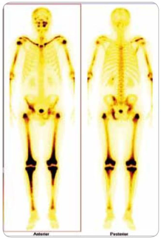 Scintigrafie skeletu: zvýšená aktivita radiofarmaka je vidět především v dlouhých kostech – oba humery ve střední třetině, v distálních částech obou femurů, v proximálních částech obou tibií, v obou klavikulách, v oblasti pánve – os ischii vlevo, os pubis vpravo, os ilium pravo, v oblasti levého SI skloubení, dále v oblasti maxily vlevo, difuzně vyšší aktivita v oblasti kalvy s ložisky vpravo parietálně a částečně frontálně bilat.