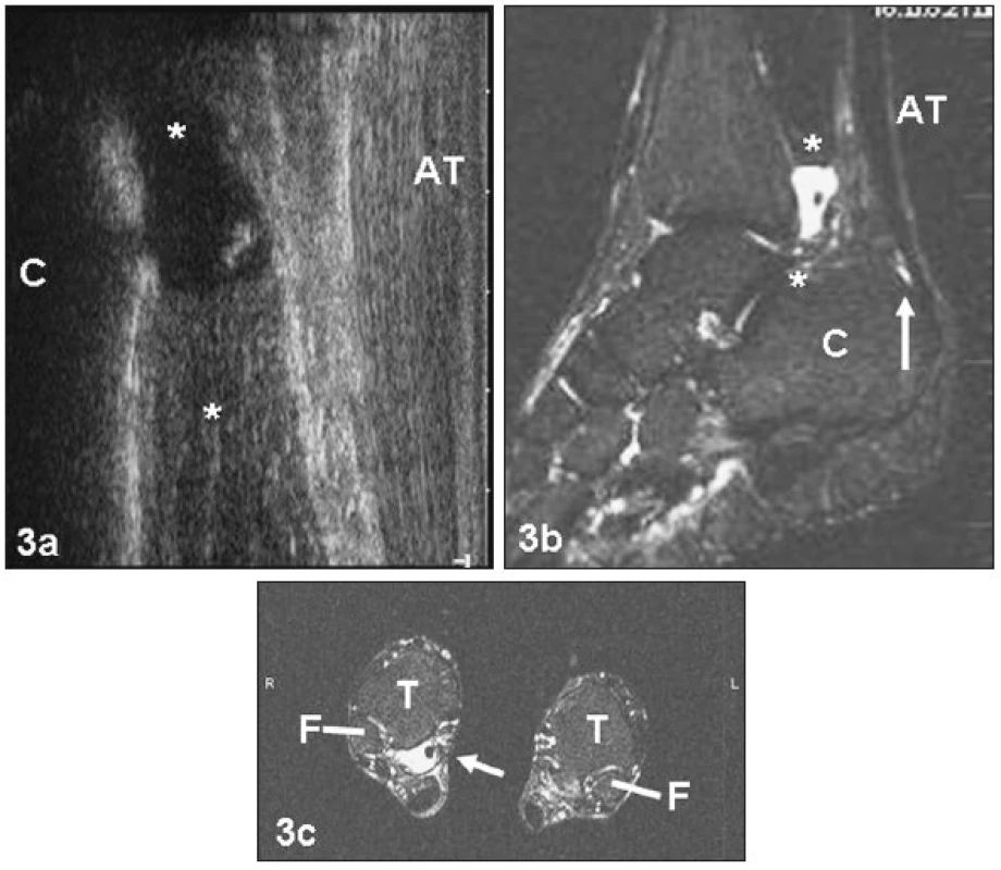 a. Kazuistika e). Ultrasonografie pravé paty zobrazující preachilární prostor s patrnou kolekcí tekutiny (**)
b. MR stejné oblasti, prostor vyplněný tekutinou označen (**), šipka označuje zvýšený signál v oblasti minimálně naplněné RB
c. MR stejné oblasti jako na předchozích obrázcích, šipka označuje rozšířenou synoviální pochvu kolem šlachy m. tibialis posterior dx. F – fibula, T – tibie
Fig. 3a. Ultrasonography of the right pre-achillar region of a 56-year-old patient (case report e – cross country runner). ** – space containing pathological fluid and a free foreign body (x)
b. MR image of the same region (the same patient as in Fig. 3a). The arrow designates the region of normally shaped signal in the region of minimally filled RB. Asterisk – the cavity containing pathological fluid and a free foreign body
c. MR image (transversal projection) of the same region as in the two previous figures. The arrow designates an enlarged synovial sheath of the right tibialis posterior muscle. F – fibula, T – tibia