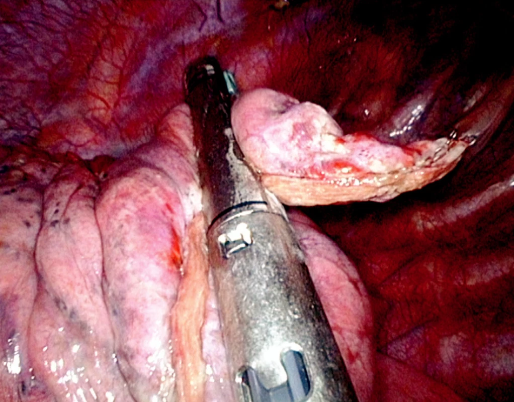 Endostaplerová resekce apexu pravé plíce (operační foto)
Fig. 3. Endostapler resection of the right pulmonary apex (intraoperative photo) 

