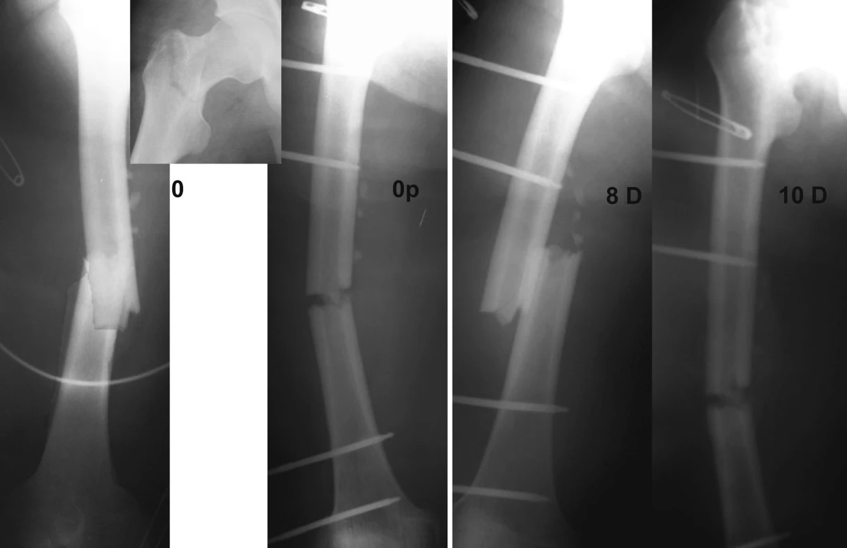 X-rays of the right femur prior to and after insertion of an external fixator