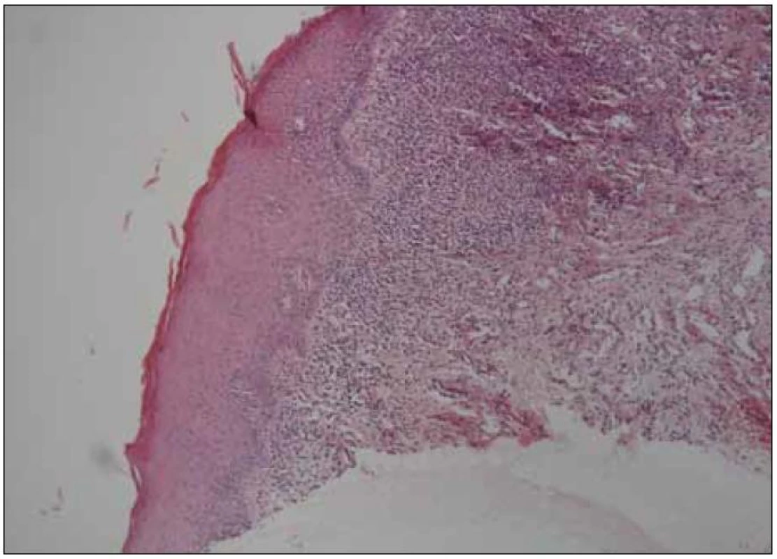 Histologický nález kompatibilní s diagnózou orální lichen planus (kazuistika 1).