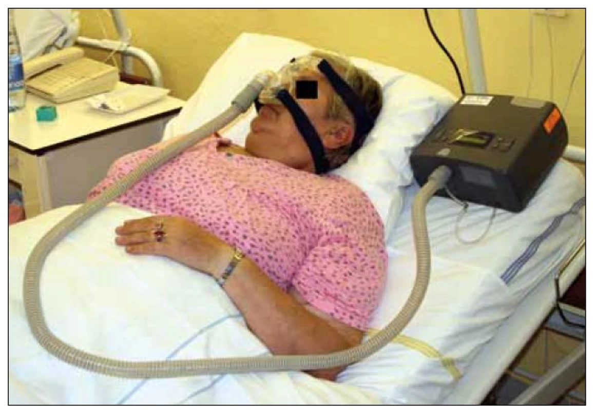 Pacientka – léčena CPAP (Continouous Positive Airway Pressure) s nosní maskou.
