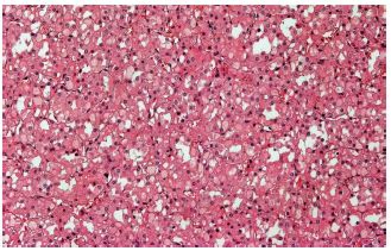 „SDHB- associated“ RK - obvykle jsou nádory solidní, tvořené populací eozinofilních buněk s vakuolizovanou cytoplasmou.