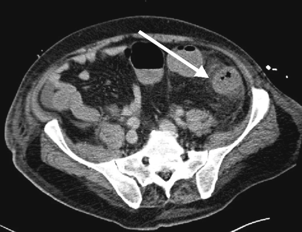 CT scan břicha, patrno prosáknutí tkání v okolí tračníku
Fig. 3. CT scan of the abdomen, infiltration of the colon-surrounding tissues is detectable
