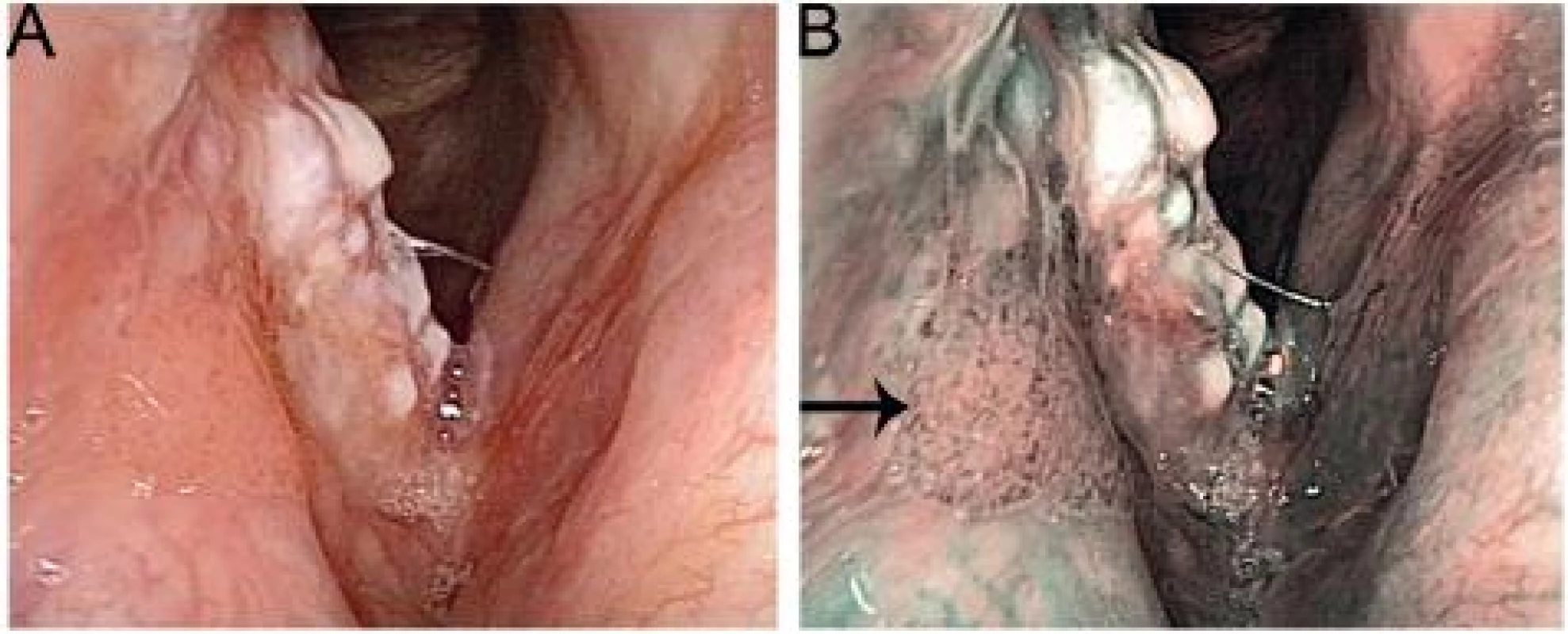 Karcinom pravé hlasivky v bílém světle (A) a NBI (B). V NBI módu je jasně patrné šíření tumoru na pravou vestibulární řasu (označeno šipkou).