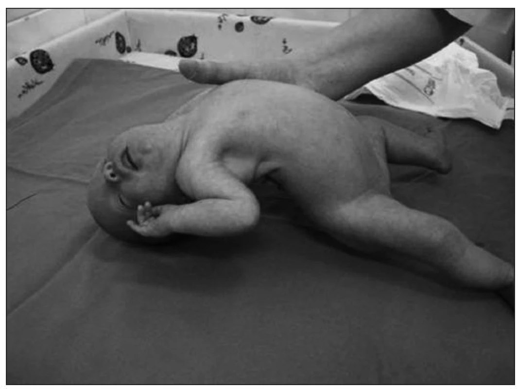 Kazuistika 1. Predčasne narodené dievčatko s PWS, ťažká globálna hypotónia.
Fig. 1. Case report 1. A premature born girl with PWS, severe global hypotonia.
