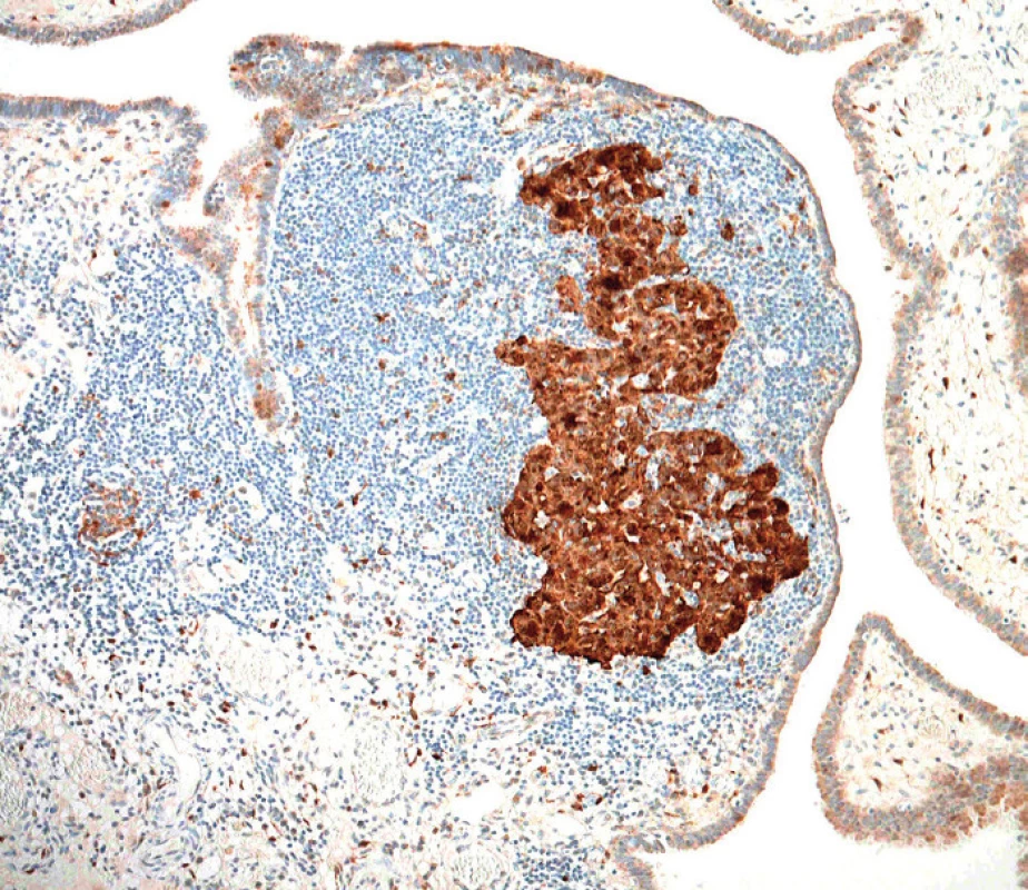 Difuzní silná jaderná a cytoplazmatická exprese proteinu p16INK4a v nádorových buňkách, v tomto případě bez vztahu k infekci lidskými papilomaviry (HPV) (původní zvětšení 100×)