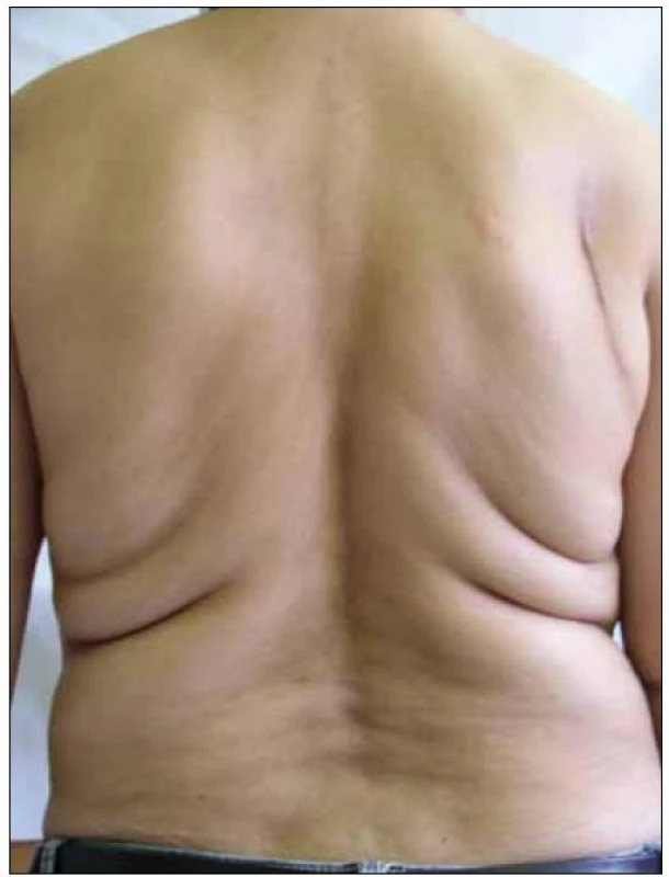 Lipohypertrofie – akumulace tuku v abdominální oblasti.