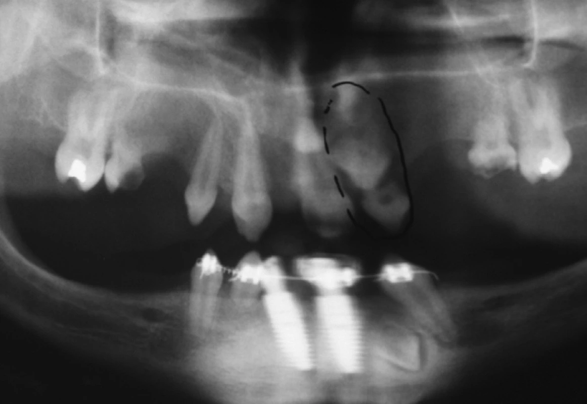 Stav po ortodontické patefakci a úpravě do ideálního postavení. Retence v dolní čelisti nebude možná pro patefakci. Semiretence v horní čelisti bude využita ke stažení do ústní dutiny.