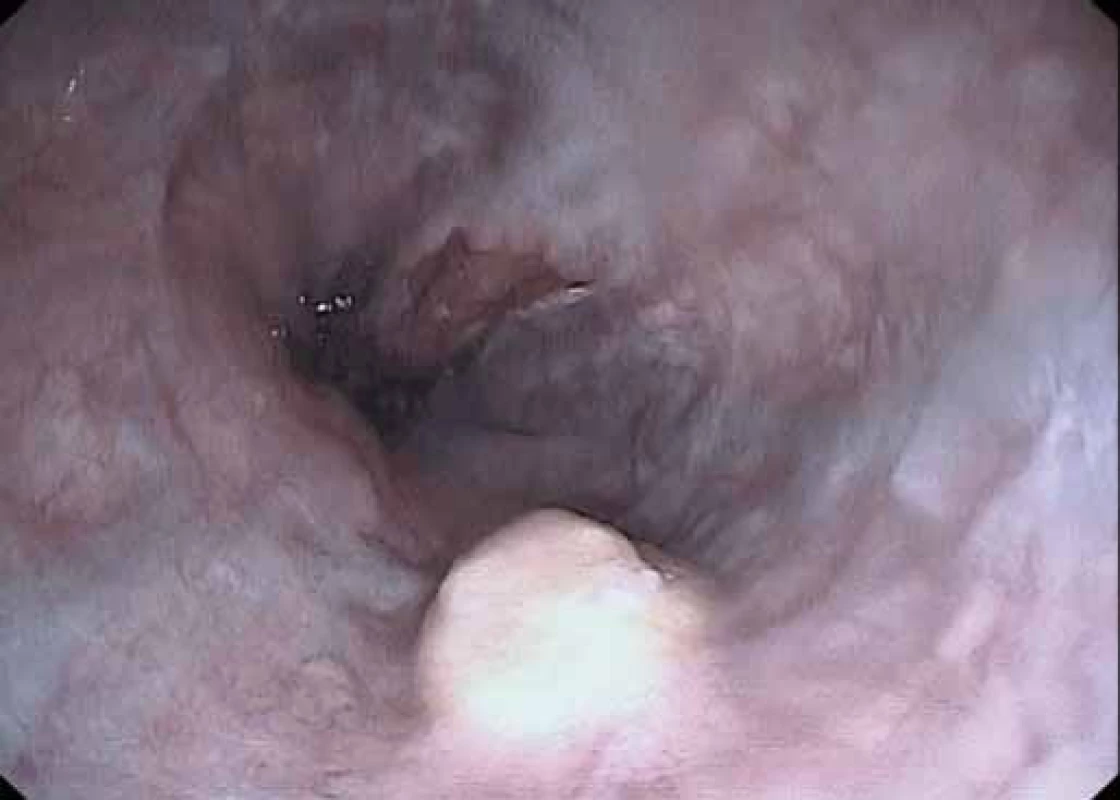 Endoskopický obraz granulárnobunkového tumoru ezofagu u 49-ročného prezentovaného pacienta. Tumor mal vzhľad asi 8 mm veľkého polypoidného útvaru žltkavej farby lokalizovaného asi 2 cm nad kardiou.
Fig. 1. An endoscopic view of oesophageal granular cell tumour in the 49-year-old presented patient. The tumour appeared as a yellowish polypoid mass of aproximately 8 mm, localised 2 cm above cardia.