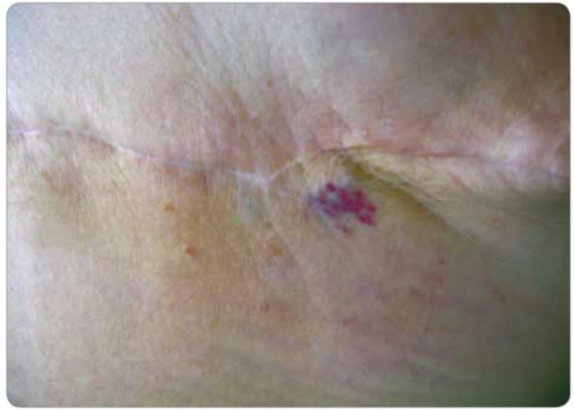 Lokální recidiva hemangiosarkomu (pacient č. 2). Nafialovělé papulky v laterální části jizvy po ablaci.