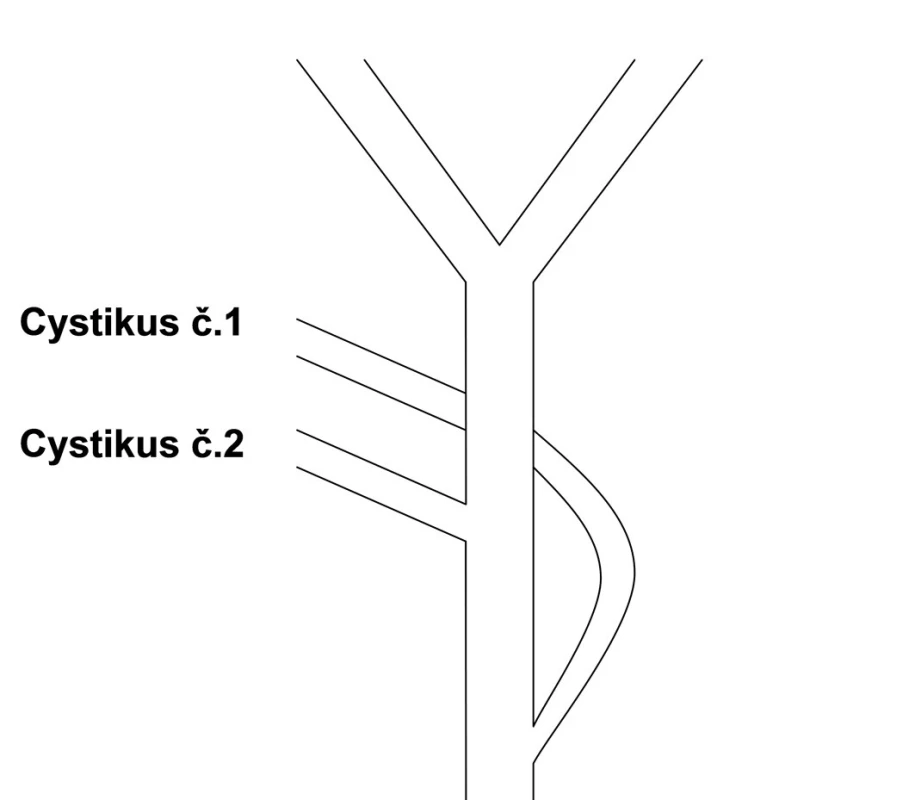 Nákres průběhu obou cystiků
Fig. 6: Diagram of both cystic ducts course
