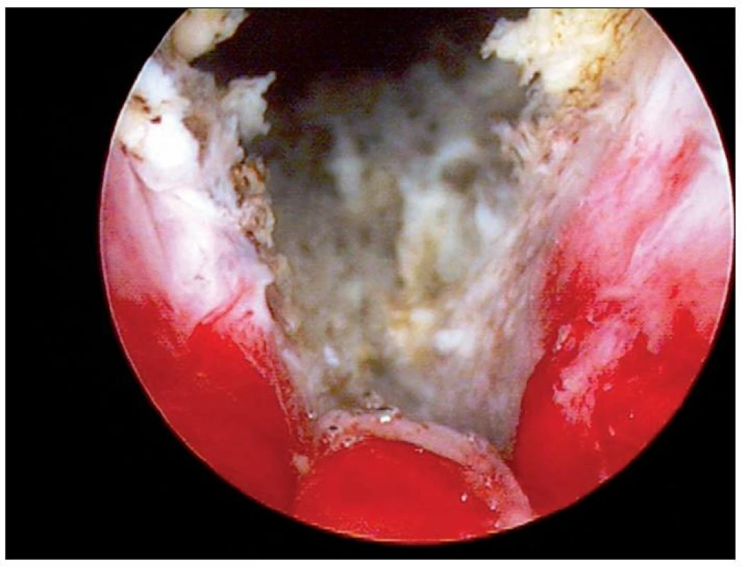 Endoskopický pohled – prostatická uretra na konci výkonu
