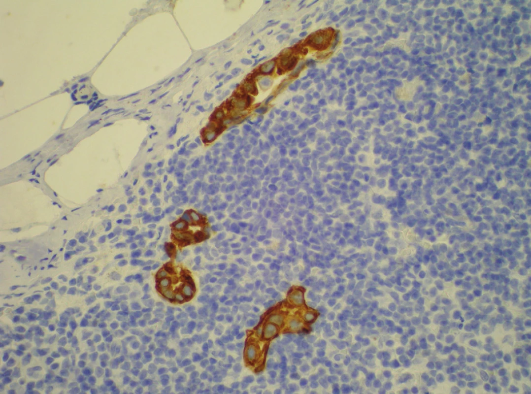 Histologický obraz mikrometastázy v parasternální uzlině. Izolované tumorózní buňky – klastry v sentinelové uzlině – imunohistochemické barvení cytokeratinem