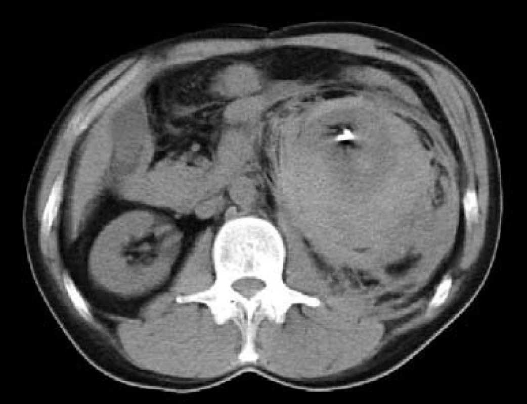 CT: Levá ledvina je dislokována ventromediálně objemným subkapsulárním hematomem (87 × 95 × 110 mm), zavedený stent do pánvičky ledviny
