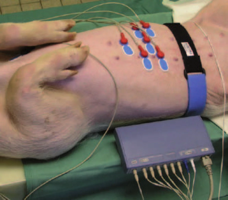 Detailní pohled na umístění sedmi elektrod a speciální abdominální pás (sloužící jako respirační senzor).
Fig. 2. Detailed view of placement of seven electrodes and special abdominal belt (functioning as a respiratory sensor).