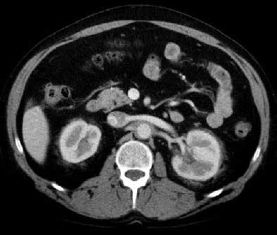 Postkontrastní CT vyšetření břicha, axiální rovina
Nepravidelně zesílená stěna břišní aorty, v pararenálním tuku zvýšené denzity a fibrózní proužky, nepravidelně ohraničená patologická tkáň i v oblasti ledvinných hilů („vlasaté“ ledviny).