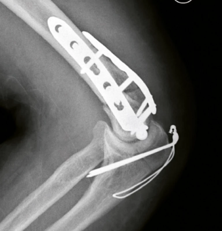 Stav po ošetření zlomeniny úhlově stabilními dlahami - pooperační bočný snímek