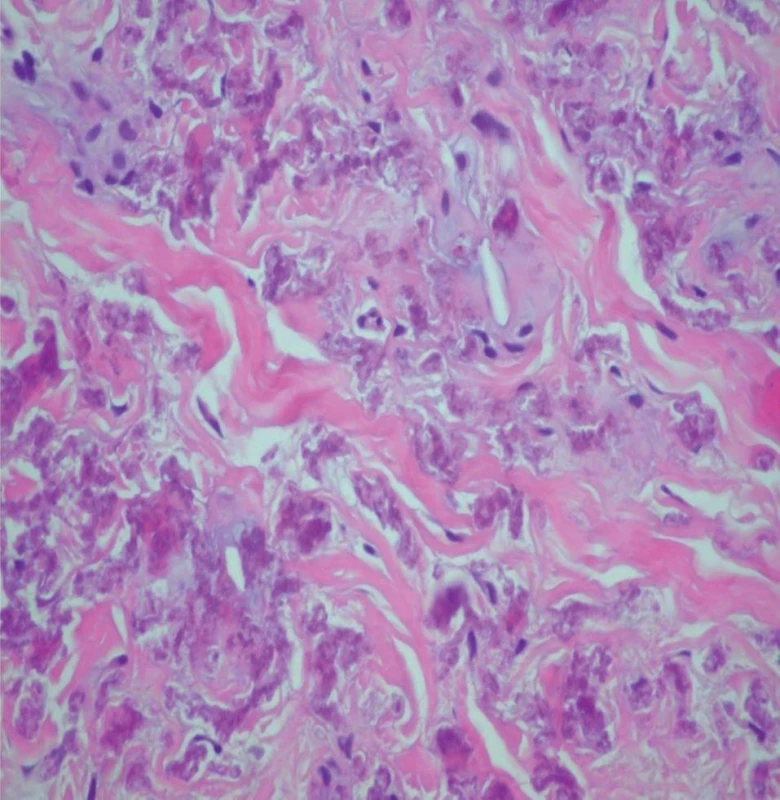 Histopatologický obraz – farbenie hematoxylín a eozín, zväčšenie: 40x – krátke, vlnité nepravidelne tvarované bazofilné elastické vlákna v strednej tretine dermis.