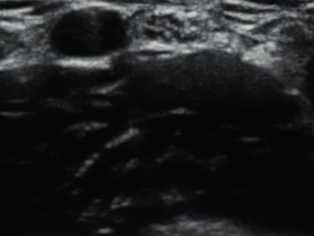 Příčný ultrazvukový obraz periferního nervu (n. medianus v kubitě) Nerv se z mediální strany přikládá k tepně (hypoechogenní oválný útvar). V nervu jsou patrny hypoechogenní (tmavé) oválné obrazy jednotlivých fasciklů. Ty jsou od sebe odděleny hyperechogenním (světlým) epineuriem.