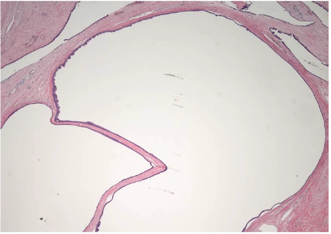 Histologický nález většiny cyst – zvětšeno 20x
Fig. 3 Histological findings of most cysts – 20 x magnification