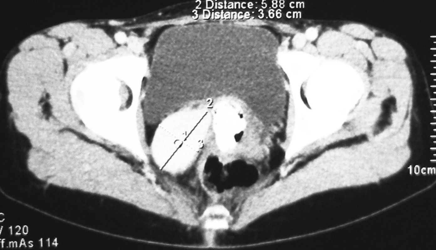 Pacient č. 2. CT obraz aneuryzmy arteria iliaca interna vpravo
Pic. 3. Patient Nr. 2: A CT scan of the internal iliac artery aneurysm on the right