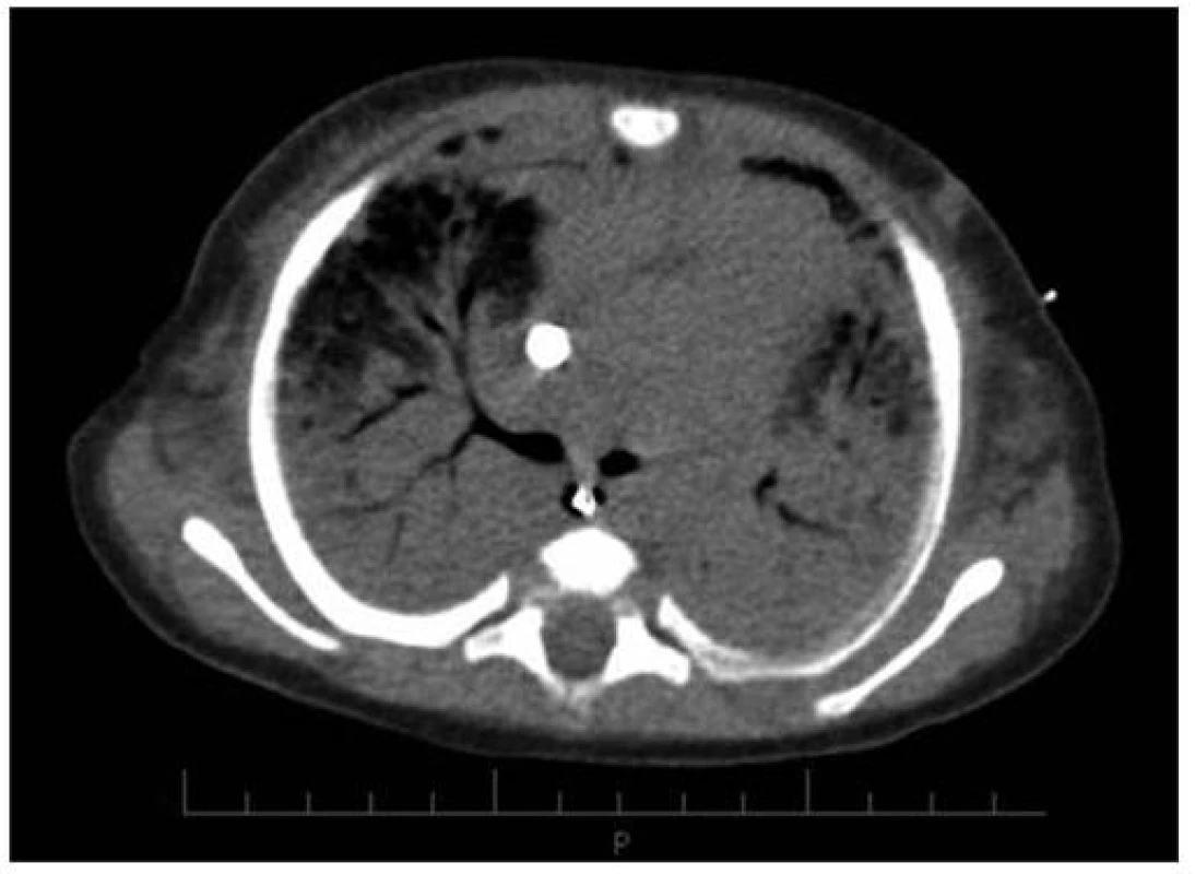 CT vyšetření 16.den (před konverzí V-V na V-A ECMO) u pacientky č. 3.
Fig. 3. CT imaging on day 16 (before V-V conversion to V-A ECMO) in female patient No. 3.