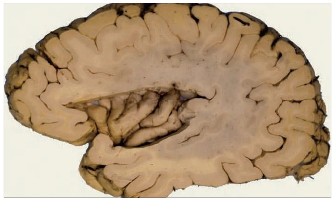 Levá insula lidského mozku. Insula je rozsáhlá korová oblast skrytá v Sylviově rýze mezi čelním a spánkovým lalokem mozku. Její objem je u lidí v relaci s makaky o 30% větší. V insule nacházíme 5 – 7 šikmých závitě, její makroskopická anatomie je však kolísavá, liší se i na levé a pravé straně téhož mozku. U lidí jsou primární interoceptivní, chuťové a vagové projekce ve střední insulární kůře, u makaků jsou projekce odlišné. Přední a spodní insulární a přilehlá operkulární kůra je lidská vývojová vymoženost, u makaků její analogie prokázána nebyla. Zpracovávání interoceptivních informací probíhá „zezadu dopředu“, kaudálně – rostrálně, na obrázku zprava doleva. Přesné propojení insuly s ostatními částmi mozku je předmětem probíhajícího výzkumu (6).