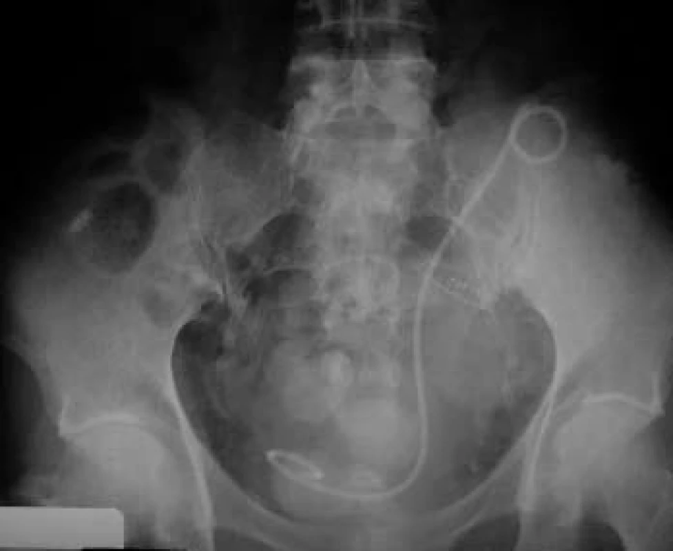 „Double J“ ureterálny stent zavedený peroperačne do dutého systému transplantovanej obličky.