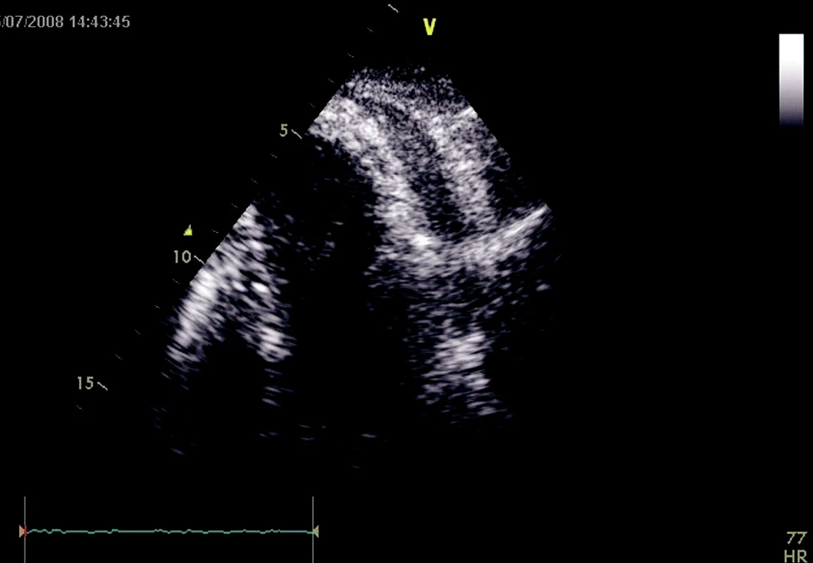 Echokardiografie: Volná tekutina v perikardiální dutině v oblasti bočné a zadní stěny . LKS a PKS