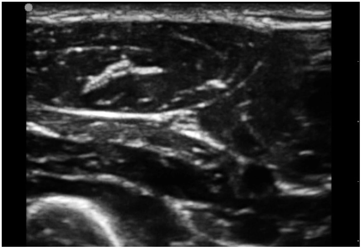 Typicky trojúhelníkovitý tvar n. ulnaris na příčném řezu asi 5cm pod loktem Z hloubky vpravo přistupuje k nervu a. ulnaris. Okolí tvoří typický obraz svalů. Vlevo v hloubce je patrná výrazně hyperechogenní linie periostu ulny. 