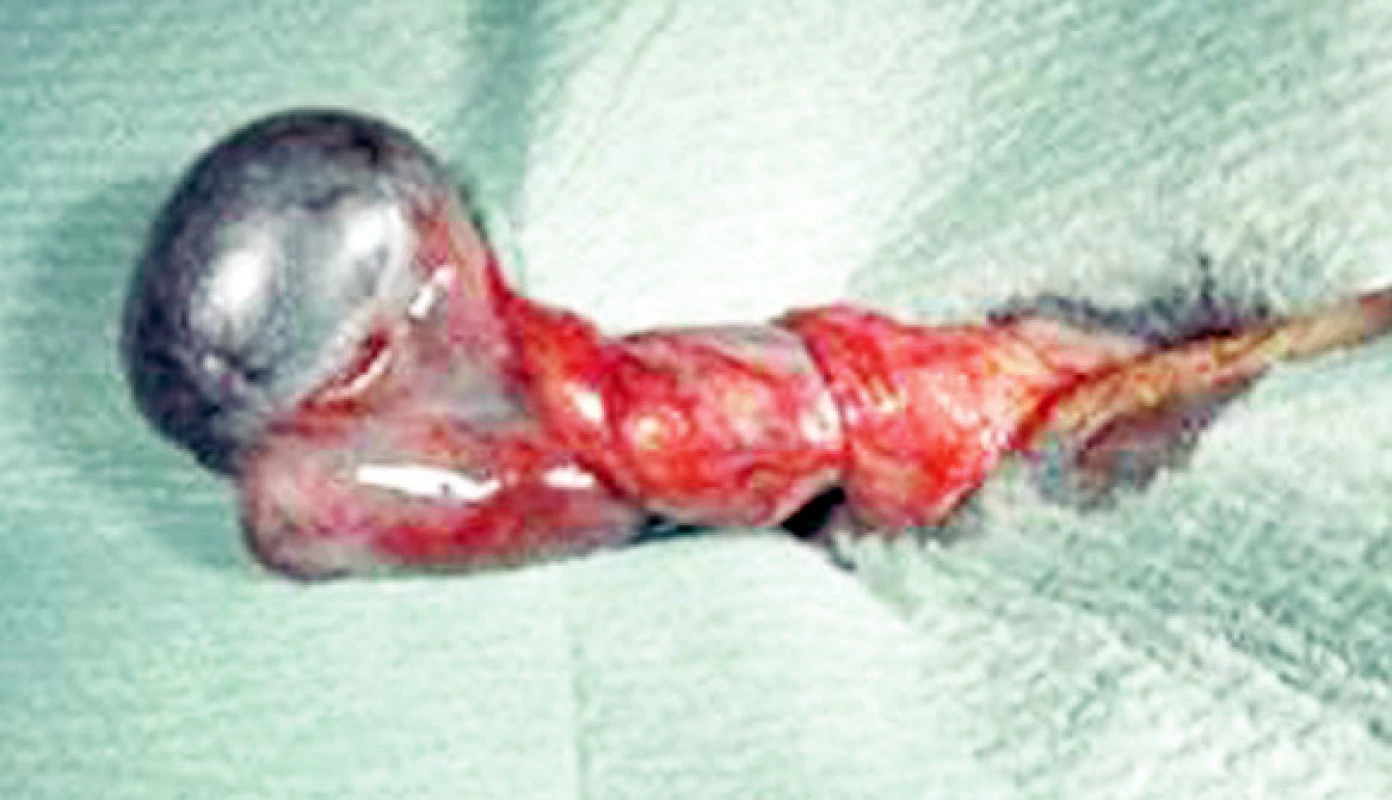 Torzia testis
Fig. 1. Testicular torsion