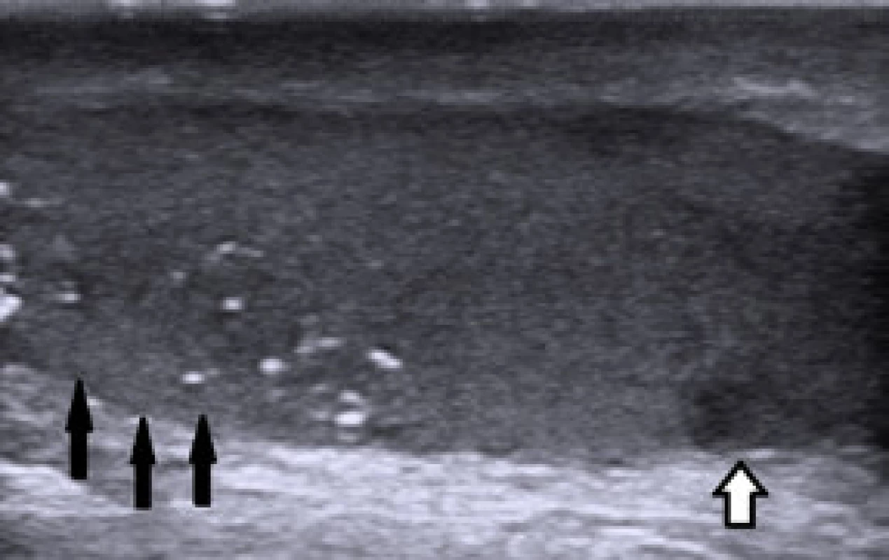 Ultrazvukový nález 5 mm hypoechogenního ložiska dolního pólu pravého varlete (bílá šipka), mikrolitiáza horního pólu varlete (černé šipky)
Fig. 3. Ultrasound finding of hypoechogenic focus, 5 mm in diameter, in distal third of right testis (white arrow), testicular microlithiasis (black arrows)