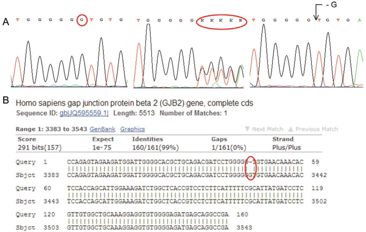 A: Sekvenogram genu pro GJB2 (Connexin 26). Jedná se o deleci báze G (vlevo referenční „wild type“ sekvence, uprostřed heterozygotní stav, vpravo homozygotní stav). Mutace je asociována s tzv. Nesyndromovou hluchotou (DFNB1). (Za poskytnutí sekvenogramů děkujeme RNDr. Martině Putzové, Ph.D.) B: Výstup z databáze BLAST – porovnání analyzované sekvence genu pro GJB2 (horní řádky „Query“) s referenční sekvencí (spodní řádky „Sbjct“). Označeno je místo bez homologie.