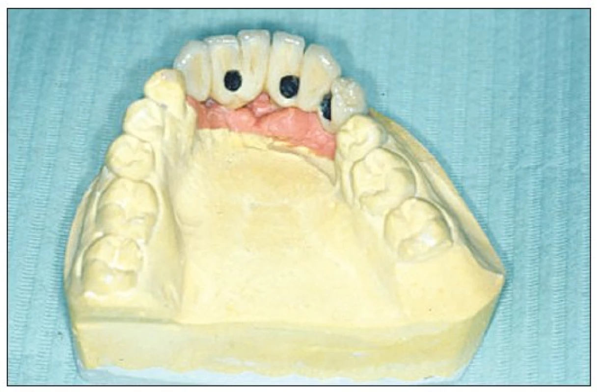 Plaster cast including gingival mask with fixed bridge