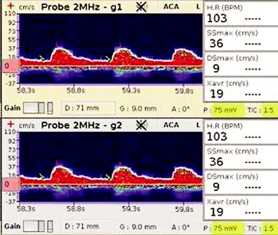 TCD záznam na a. cerebri media Zobrazuje nízké maximální rychlosti v systole a diastole (SSmax a Dsmax), nízkou průměrnou maximální rychlost (Xavr).