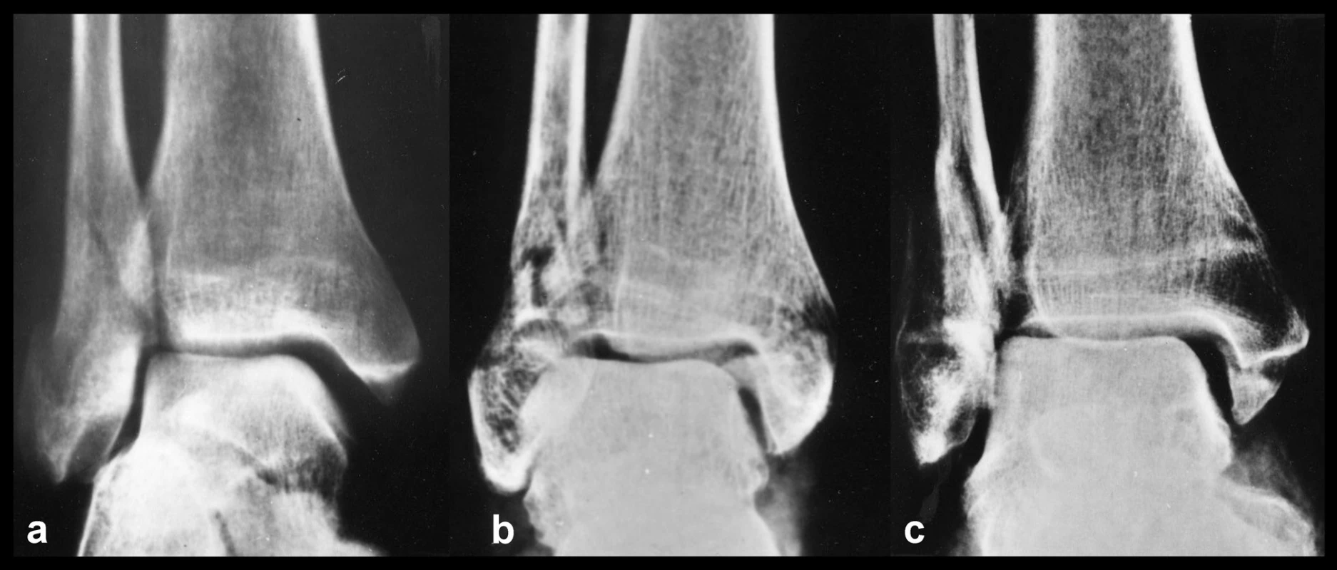 Tři základní typy poranění mediálních struktur
a – ruptura deltového vazu, b – zlomenina vnitřního kotníku, c – kombinované osteo-ligamentózní poranění