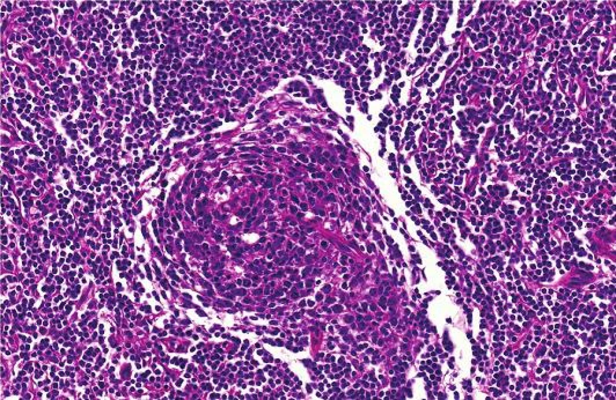 Detailní histologické zobrazení Castlemanovy choroby
Fig. 4 : Detailed image of Castleman´s disease
