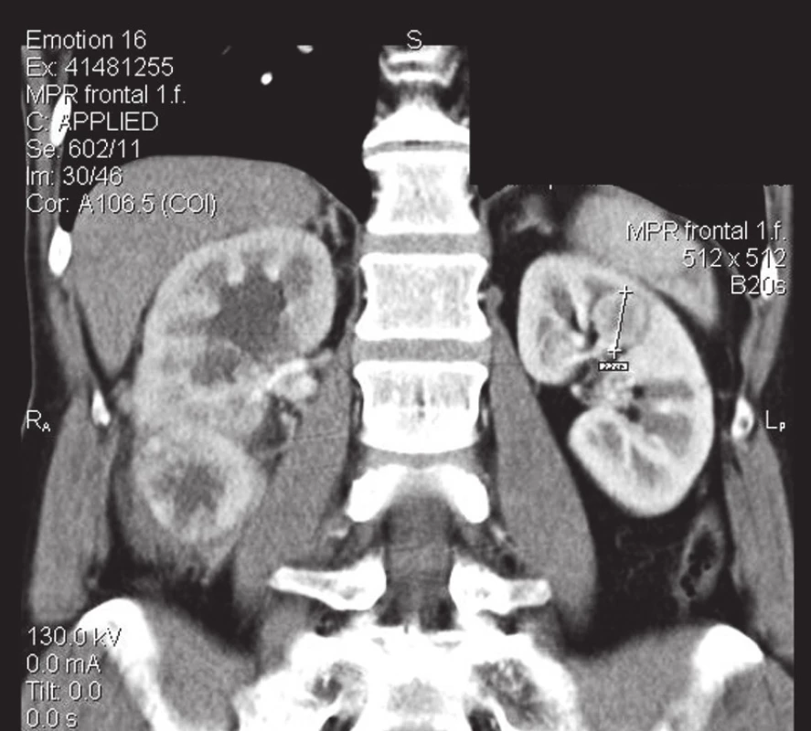 Tumor levé ledviny
Fig. 2. The tumor of the left kidney
