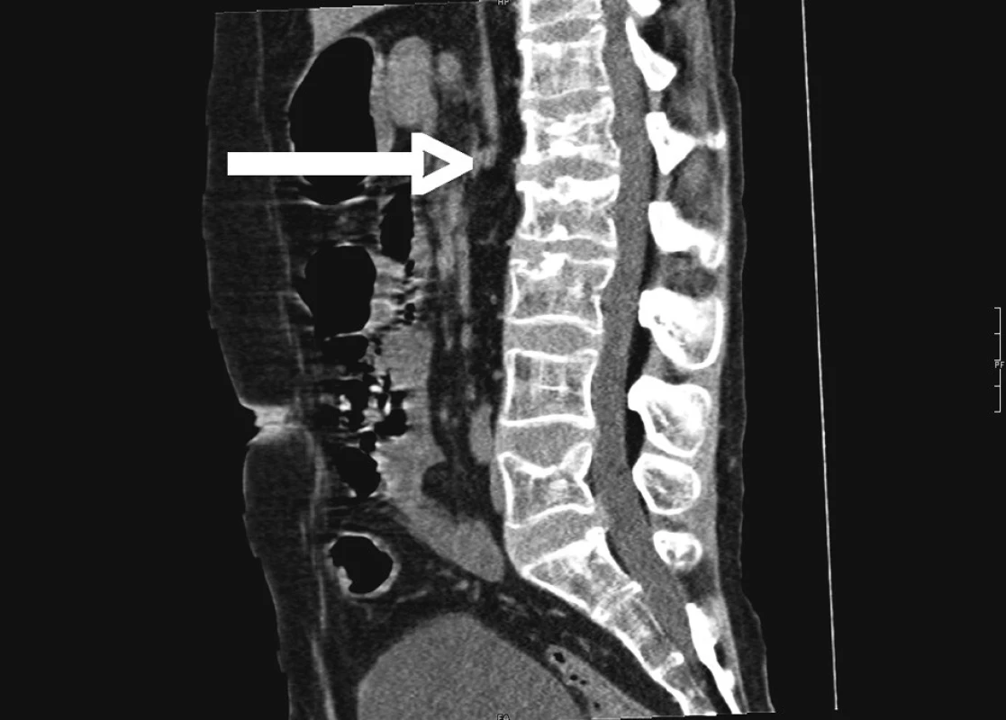 RTG chrbtice pacienta s ulceróznou kolitídou
Fig. 3. Spine X-ray picture of patient with UC