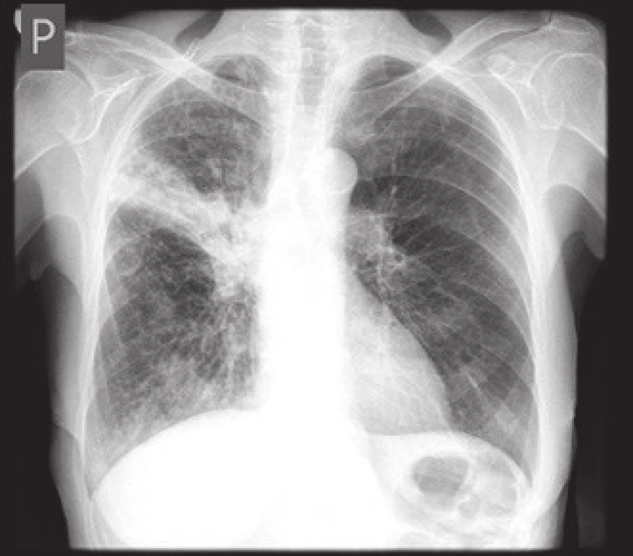 RTG obraz infiltrace vpravo ve středním plicním poli s vytažením a zvětšením pravého hilu.
Fig. 1. Chest X-ray image of infiltration of the right pulmonary mid-lobe with shift and enlargement of the right hilus.
