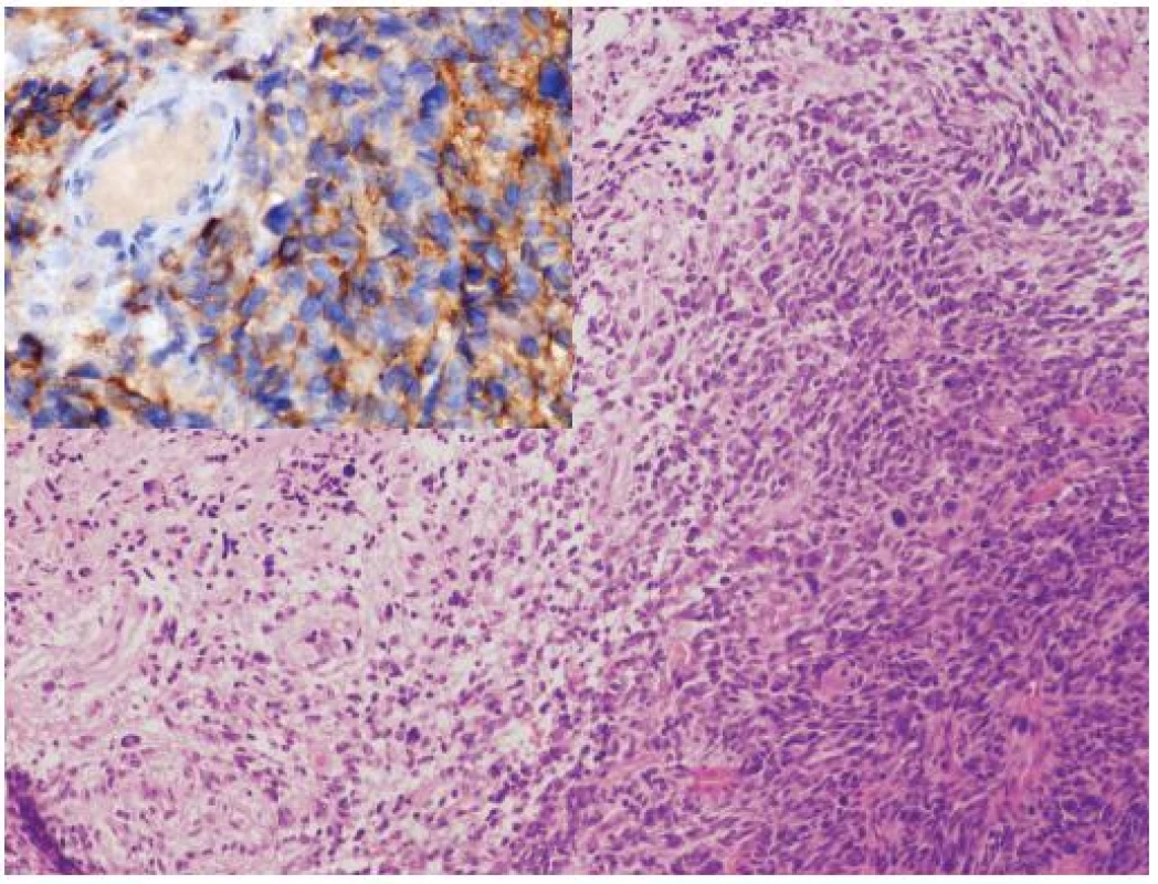 Glioblastóm s PNET-like diferenciáciou. 8-ročná pacientka s metastázou v mieche po dvoch rokoch od primárnej diagnózy. Nádor mal v primárnom ložisku zmiešanú morfológiu glioblastómu (vľavo) s fókusmi pripomínajúcimi PNET (vpravo). V metastáze bola prítomná iba PNET-like diferenciácia, ktorá bola imunohistochemicky synaptofyzín a MAP2 pozitívna (vložený obrázok), bez expresie GFAP. Amplifikácia MYC a MYCN v tomto prípade nebola prítomná. Hematoxylín-eozín, zväčšenie 200 x a imunohistochémia MAP2, zväčšenie 400 x.