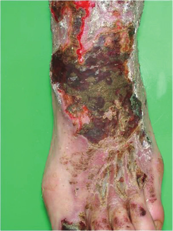 Akutní iritační dermatitida po solích chrómu (cauterisatio)