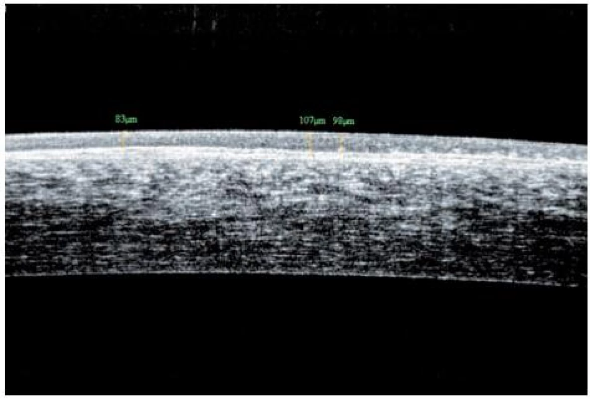 Edém epitelu rohovky, nepravidelnost bazalní membrány (OCT snímek – oční koherenční tomografie)