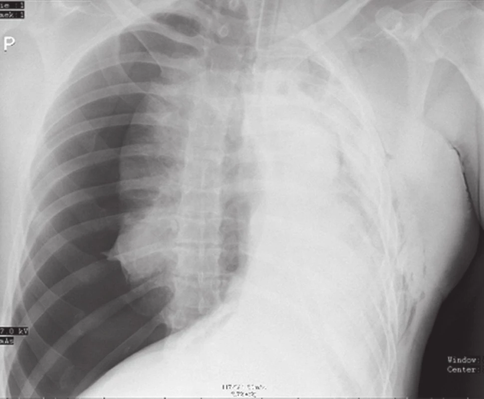 RTG obraz pravostranného traumatického tenzního pneumotoraxu
Fig. 1: X-ray image of right-sided traumatic tension pneumothorax