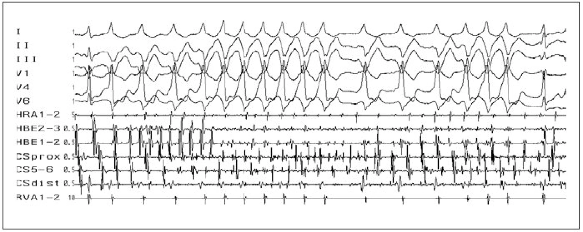 Fibrilace síní. Fibrilace síní (rychlé a nepravidelné, chaotické, síňové potenciály ve svodech HRA, HBE a CS), v povrchových svodech s různě vyjádřeným stupněm preexcitace (různě široké QRS-komplexy) u pacienta s akcesorní spojkou v posteroseptální oblasti (negativní delta-vlna ve svodech II, III).
