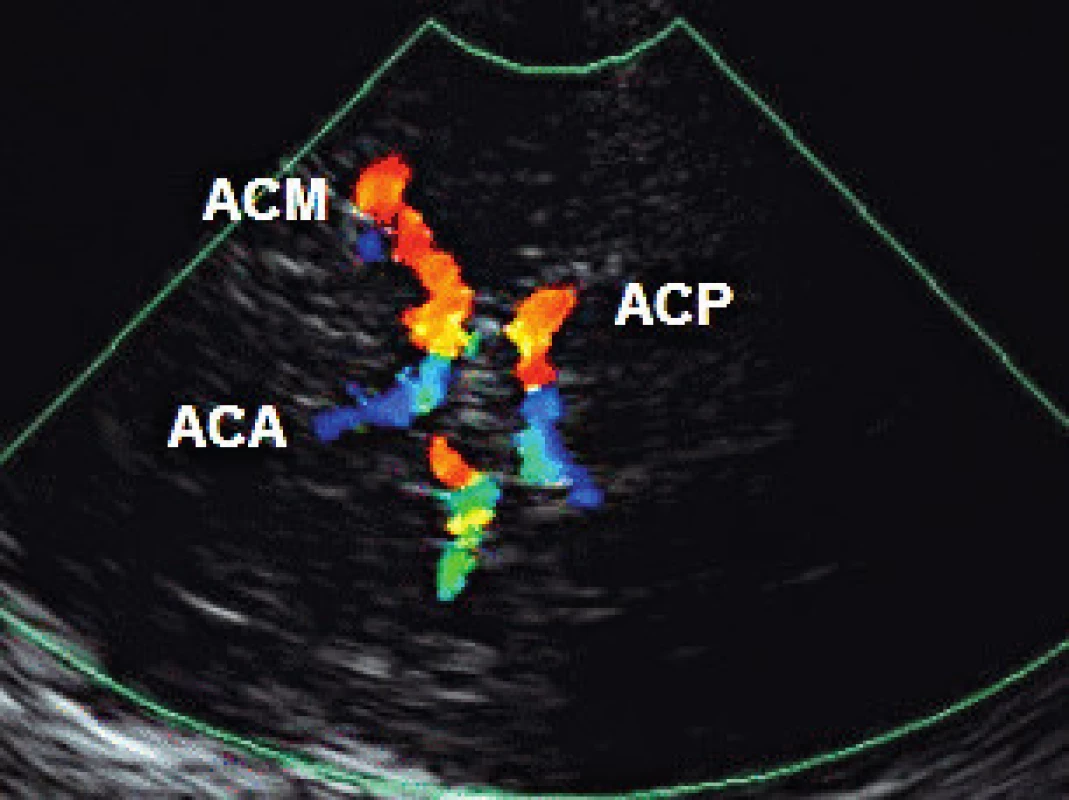 Transtemporální přístup – zobrazení hlavních mozkových tepen: a. cerebri anterior (ACA), a. cerebri media (ACM), a. cerebri posterior (ACP)