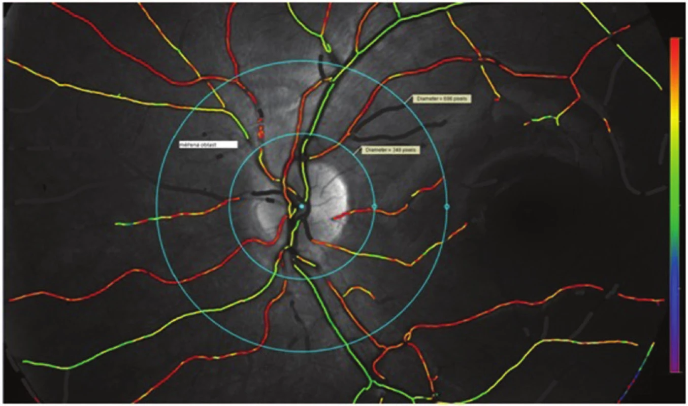 Oční pozadí pacienta se zobrazením saturace krve v sítnicových cévách pomocí barevné škály. Na obrázku je patrná měřící oblast (measurement zone), která je ohraničena dvěma soustřednými kružnicemi o velikosti 1,5 PD a 3 PD s centrem obou kružnic v centru papily