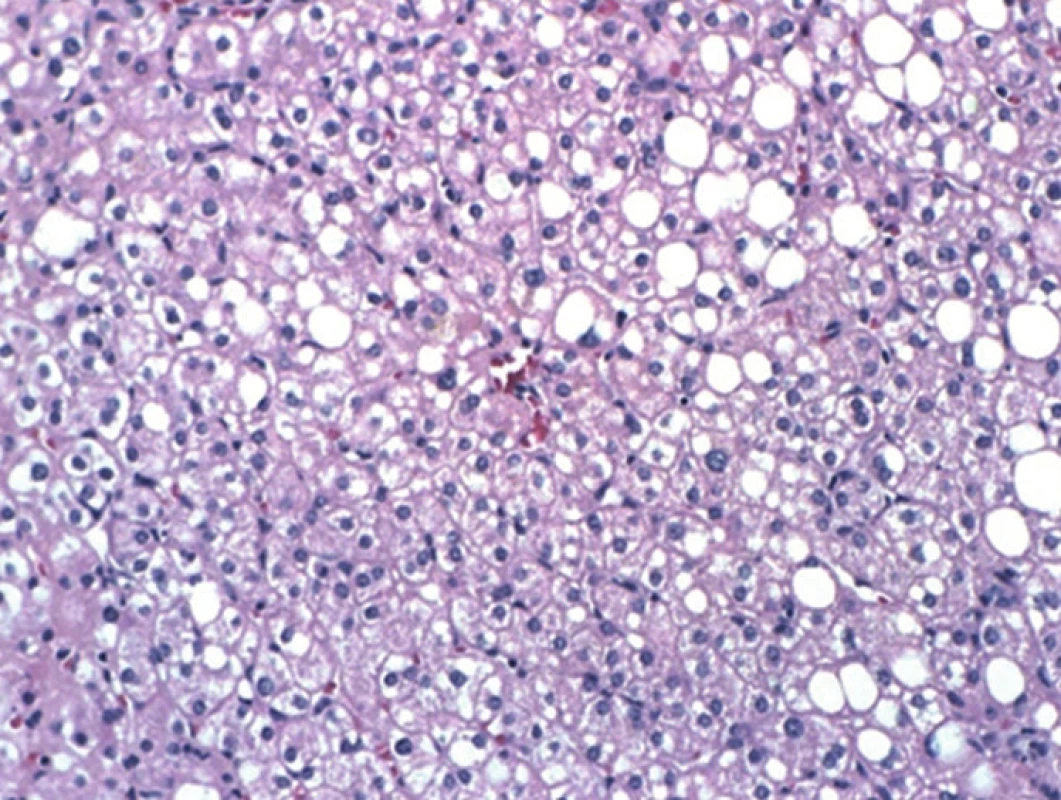 Jaterní tkáň ze segmentu 4b s centrální vénou a v okolí hepatocyty s velkokapénkovou i malokapénkovou steatózou, HEM, 20x, Olympus AH3-RFCA
Fig. 5: Histological specimen. Liver tissue from segment S4b; central vein and macro- and micro-vesicular steatosis of the surrounding hepatocytes, HEM, 20x, Olympus AH3-RFCA